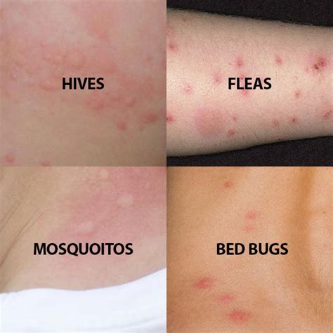 bed bugs don't bite.